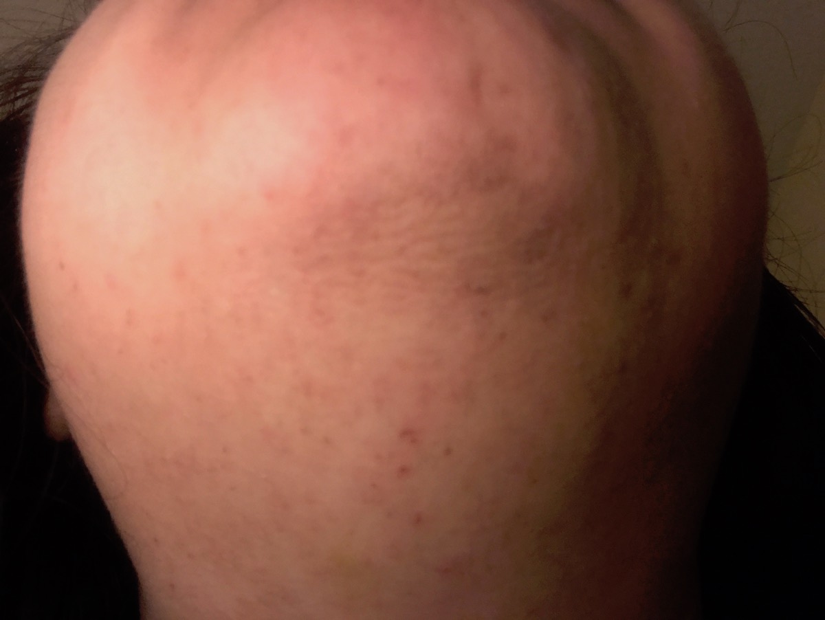 After Electrolysis