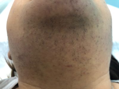 polycystic ovary syndrome facial hair on a woman's chin