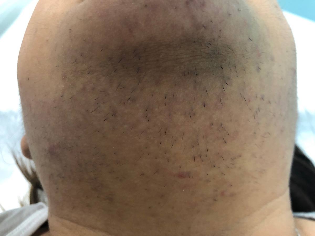 polycystic ovary syndrome facial hair on a woman's chin