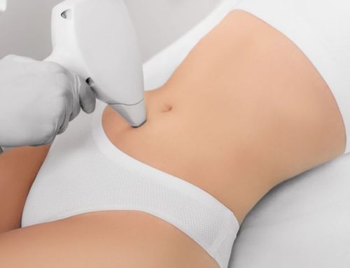 Laser Hair Removal
